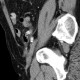 Acute appendicitis: CT - Computed tomography